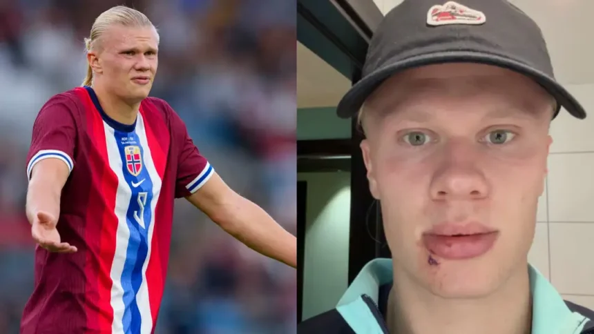Erling Haaland suffers freak injury from bus door but avoids serious setback on Norway duty